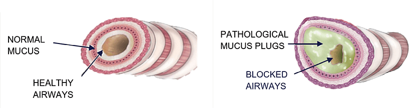 Comparison of healthy versus obstructed airways, highlighting the mucus challenge in respiratory diseases targeted by CILA Therapeutics.