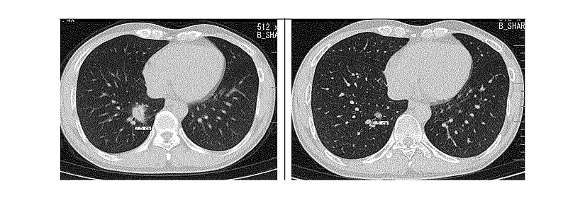 Lung radiographies abstracted from Medilink's patent.